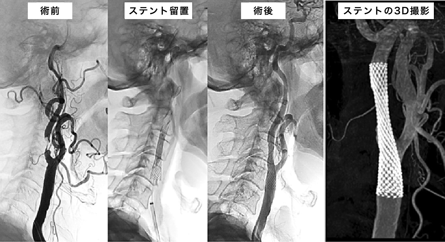 ステント血栓症はどのように診断されますか?