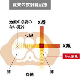 従来の放射線治療