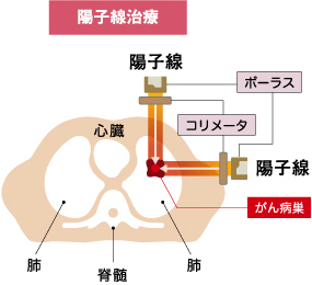 陽子線治療