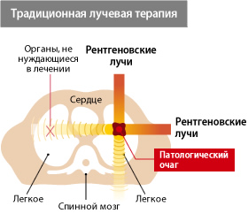 Traditional radiation therapy