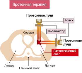 Proton therapy